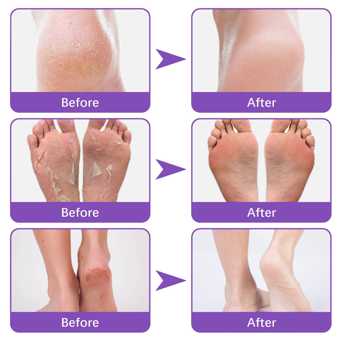 Foot Skin Chapped Exfoliating Exfoliating Exfoliating Skin Moisturizing And Nourishing Foot Mask
