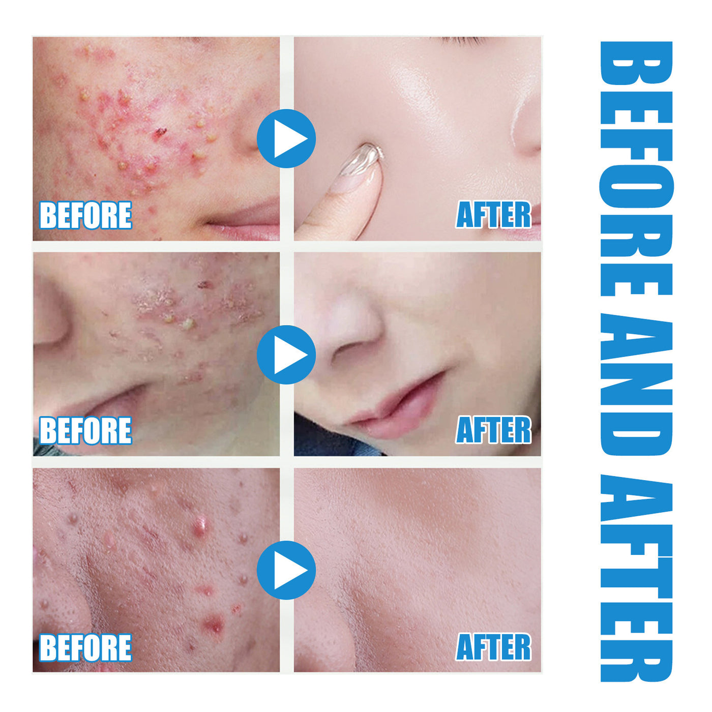 Hyaluronic Acid Replenishment